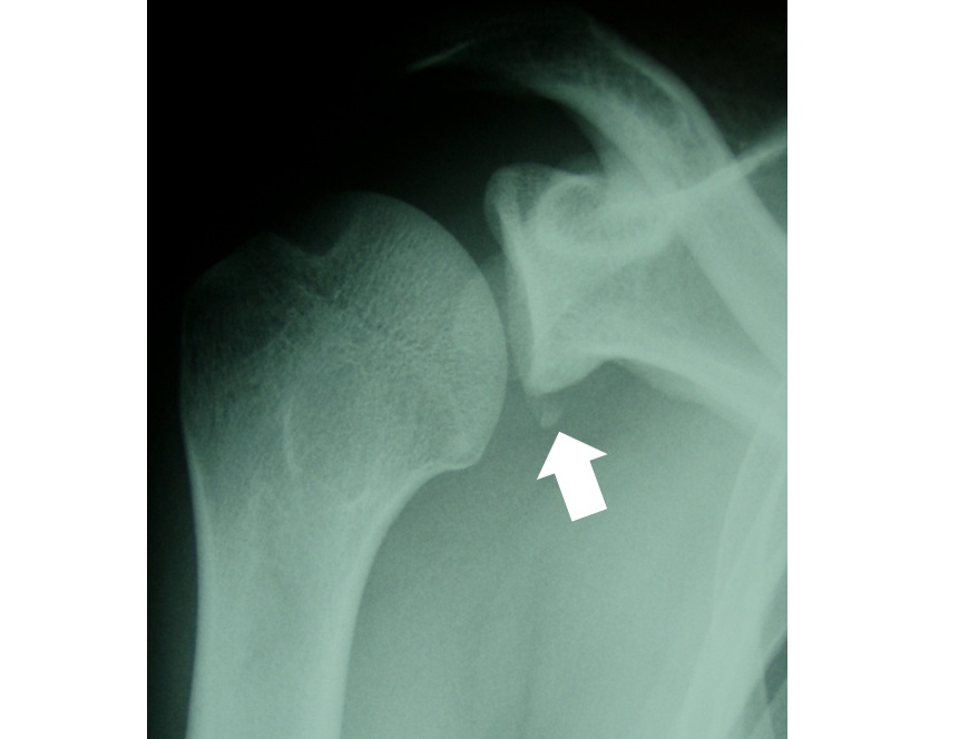 照片4 關節邊緣的撕脫骨折。或者說是肩胛骨關節盂下緣前方骨折
