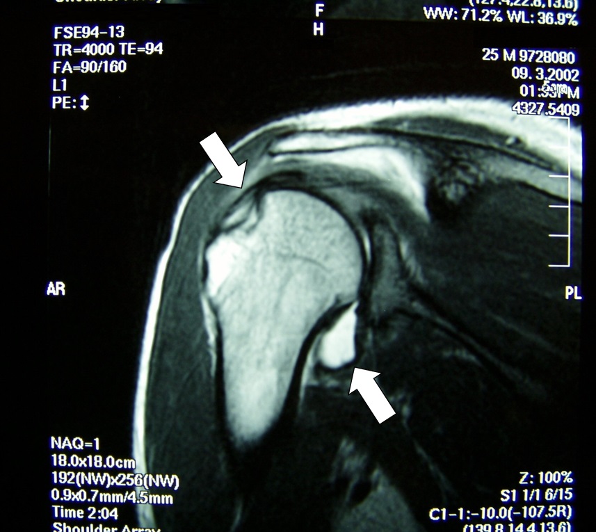 照片2 整復後的MRI圖像。肱骨周圍由於出血顯示為高信號（白色）