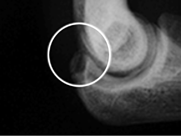 FIG. 2 Olecranon type: ulna Olecranon view of bony dehiscence