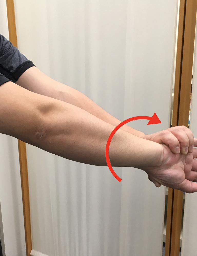 Tennis elbow 1
