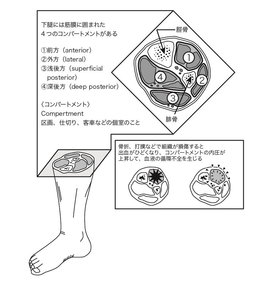 Compartment syndrome diagram