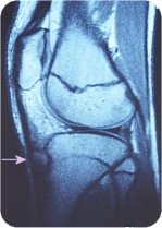 Osgood MRI