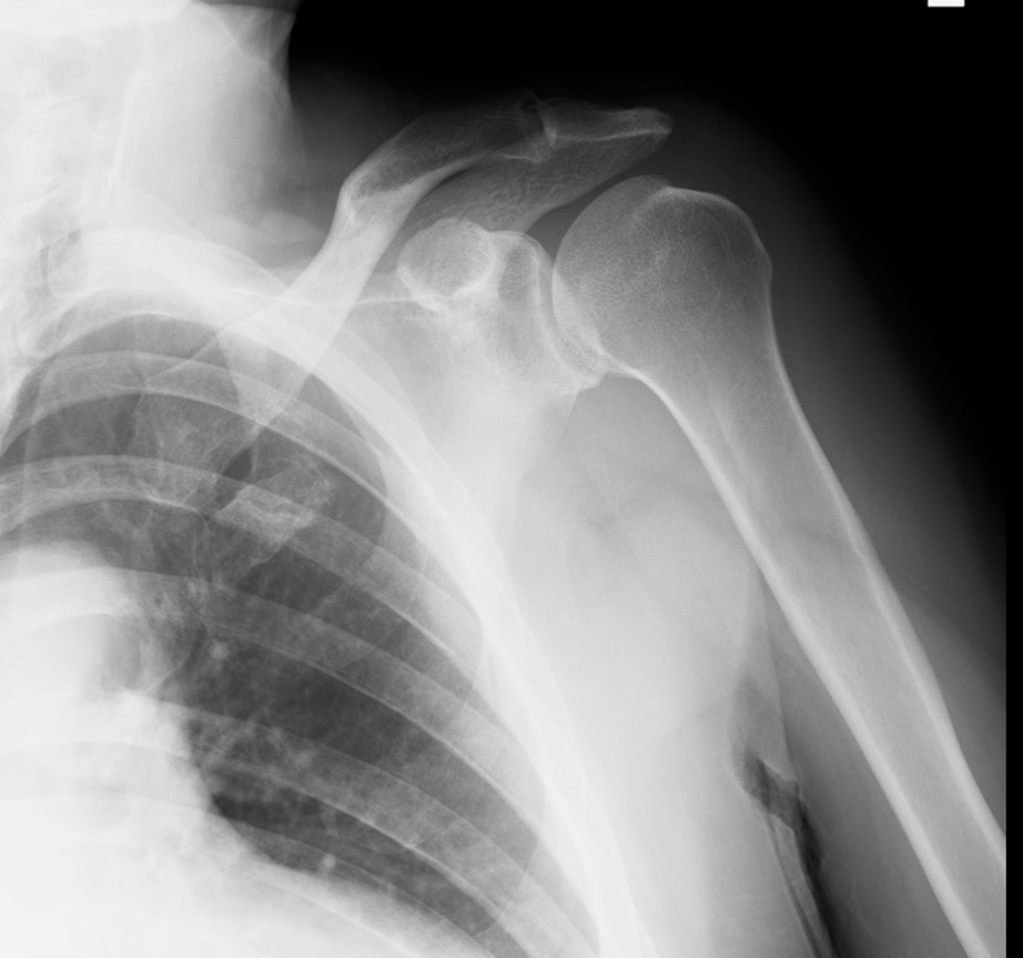 照片3 左肩關節脫位整復後的X光照片