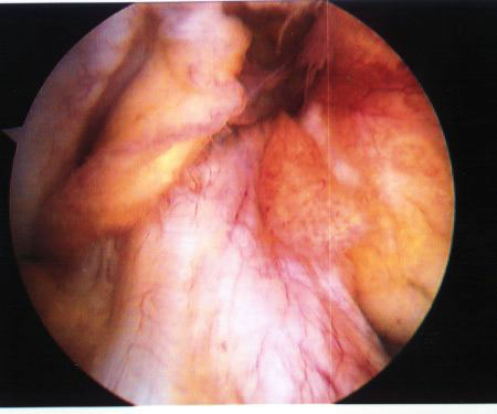 Photo: Arthroscopic photograph of an ACL mild injury. The ligaments are relaxed, but their morphology is preserved.