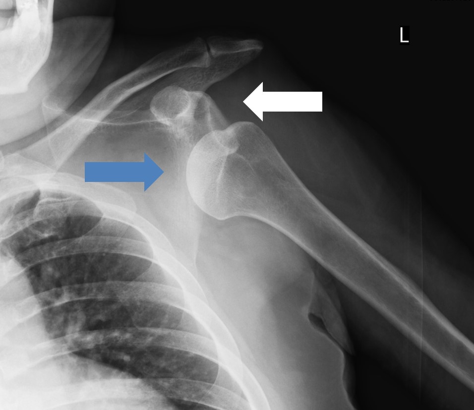 照片1 左肩關節脫位（白色箭頭是骨頭本來的位置）