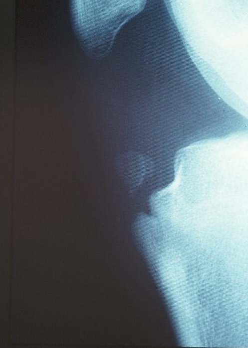 Osgood X-ray