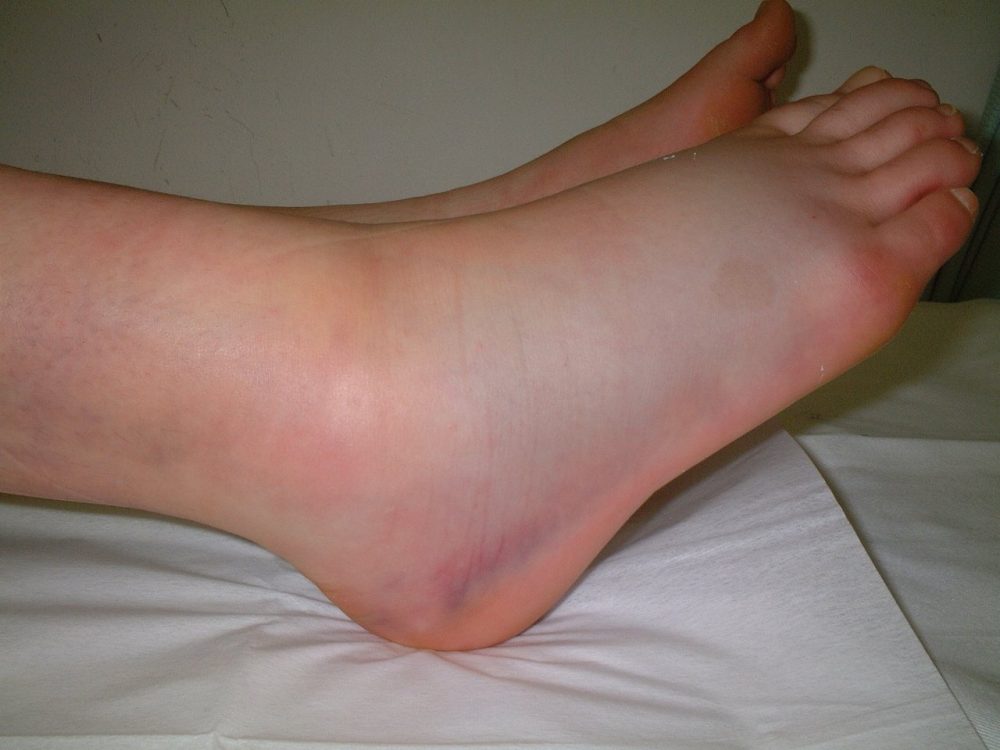 Varus sprain photograph 1