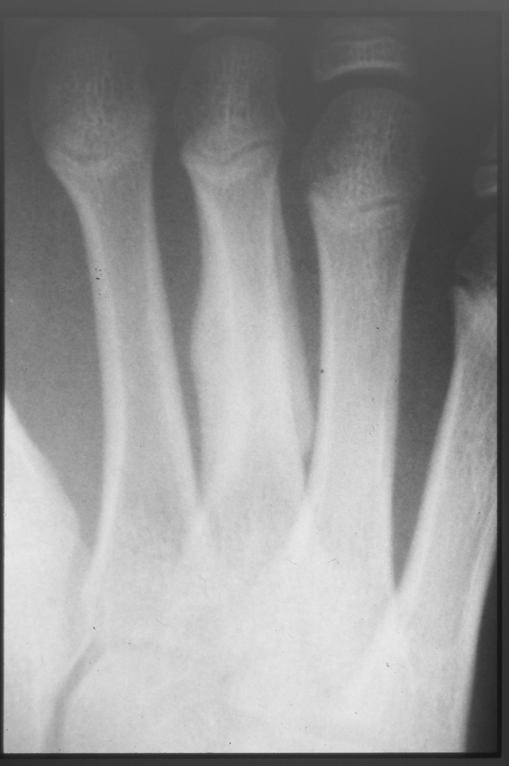 Jones fracture X-ray 3