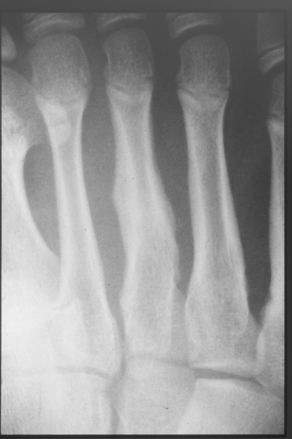 Jones fracture X-ray 2