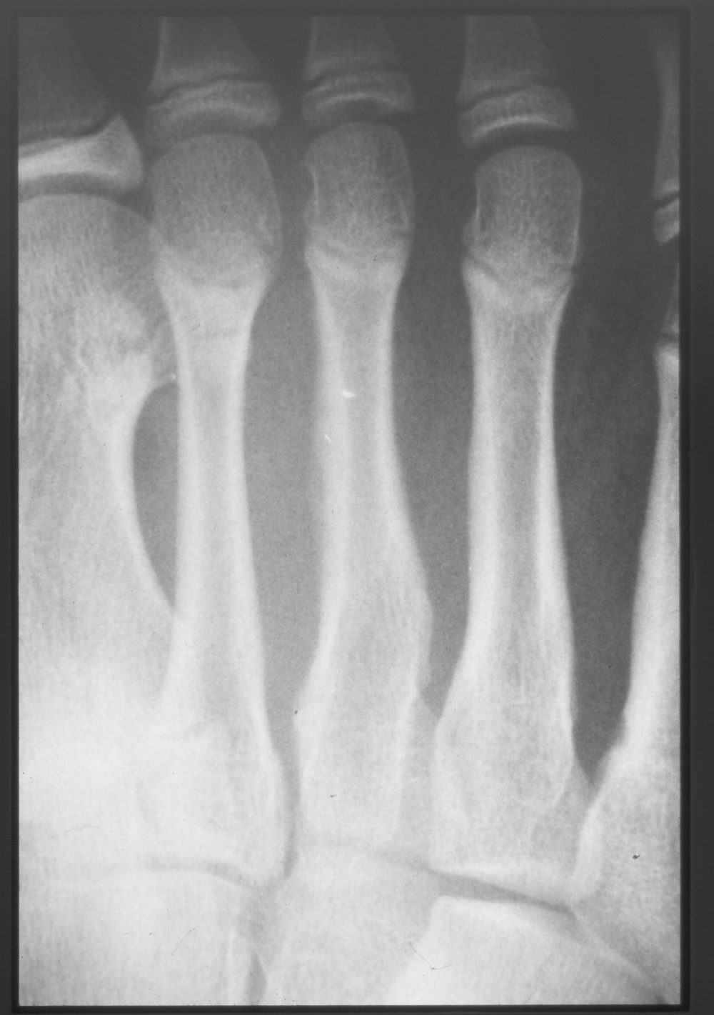 Jones fracture X-ray 1